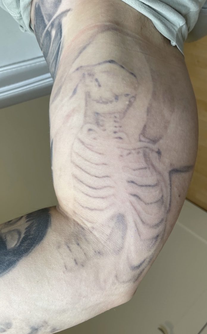 Tattoo after 15 laser tattoo removal sessions at Goodbye Rhonda