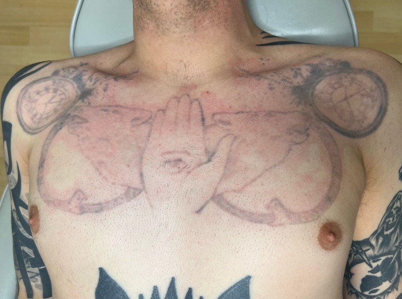 Tattoo after 9 laser tattoo removal sessions at Goodbye Rhonda