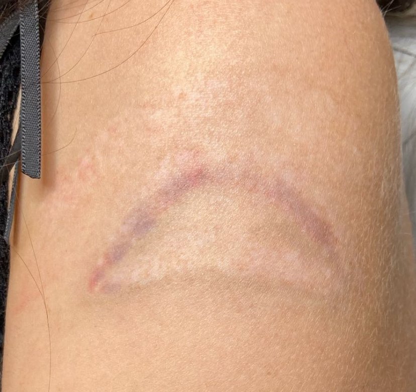 Tattoo after 13 laser tattoo removal sessions at Goodbye Rhonda