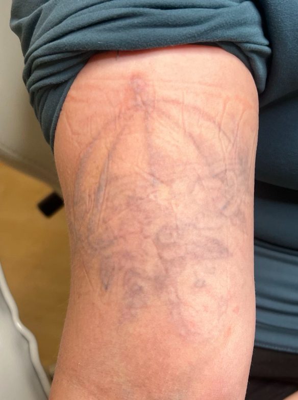 Tattoo after 15 laser tattoo removal sessions at Goodbye Rhonda
