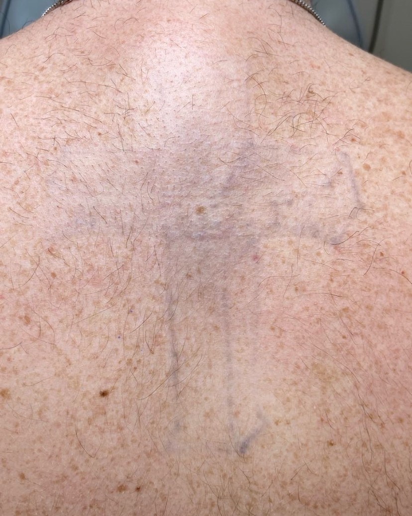 Tattoo after 14 laser tattoo removal sessions at Goodbye Rhonda