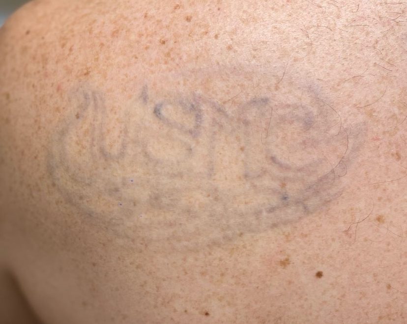 Tattoo after 14 laser tattoo removal sessions at Goodbye Rhonda