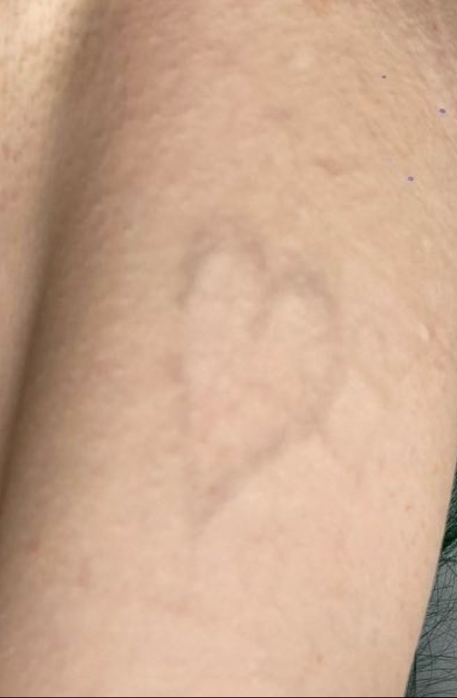 Tattoo after 14 laser tattoo removal sessions at Goodbye Rhonda