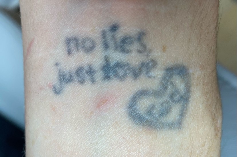 Tattoo before laser tattoo removal at Goodbye Rhonda