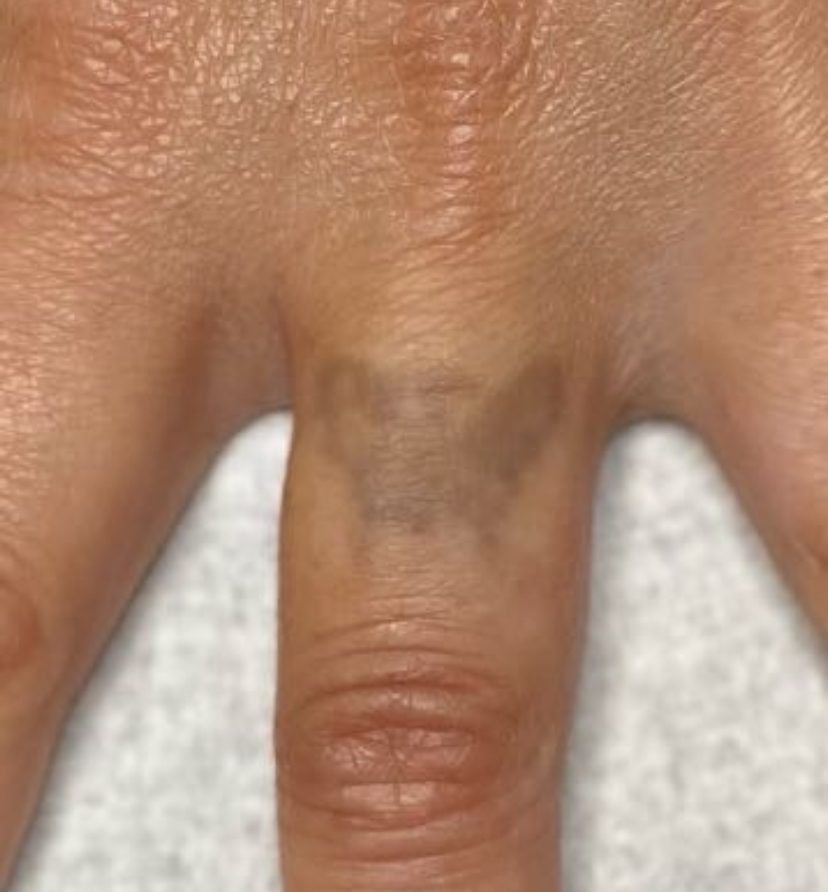 Tattoo after 8 laser tattoo removal sessions at Goodbye Rhonda