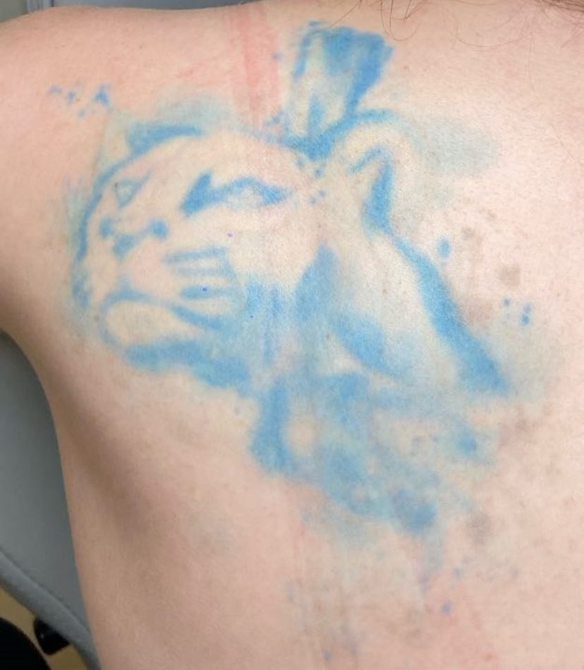 Tattoo after 9 laser tattoo removal sessions at Goodbye Rhonda