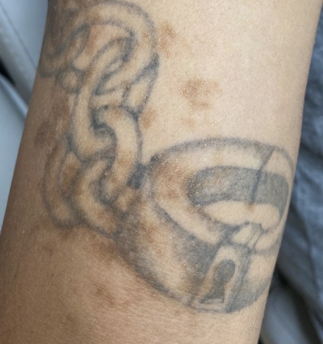 Tattoo before laser tattoo removal at Goodbye Rhonda