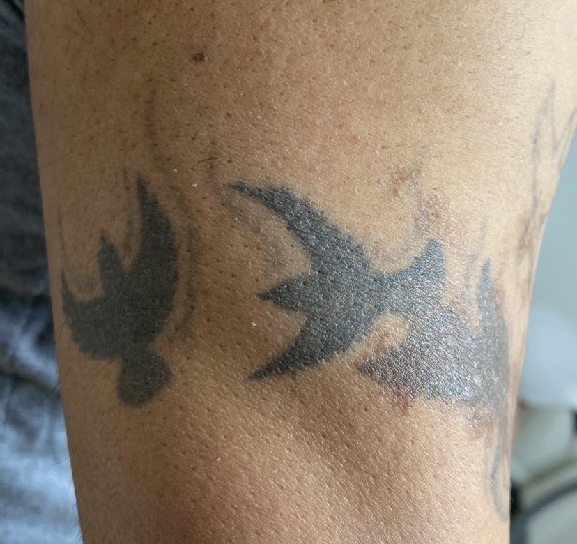 Tattoo before laser tattoo removal at Goodbye Rhonda
