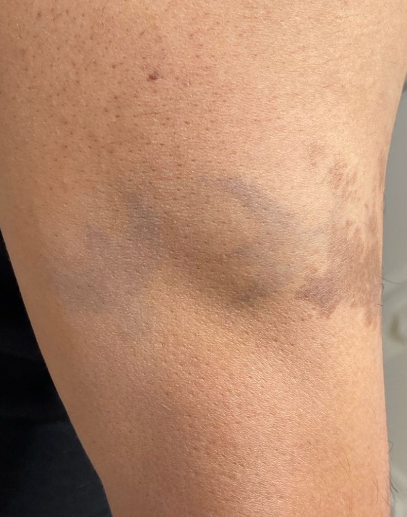 Tattoo after 9 laser tattoo removal sessions at Goodbye Rhonda