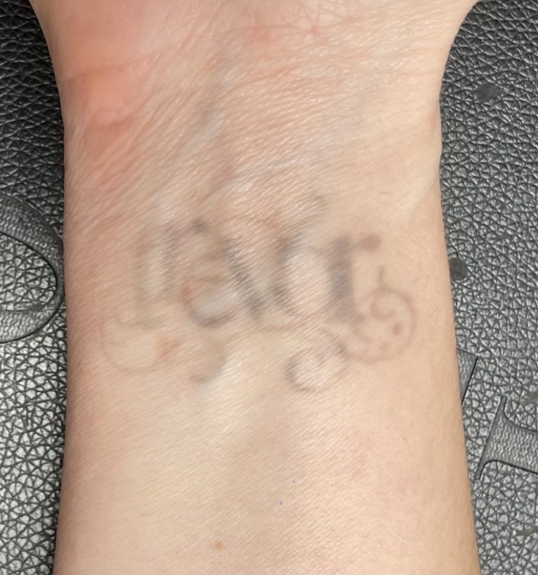 Tattoo after 5 laser tattoo removal sessions at Goodbye Rhonda