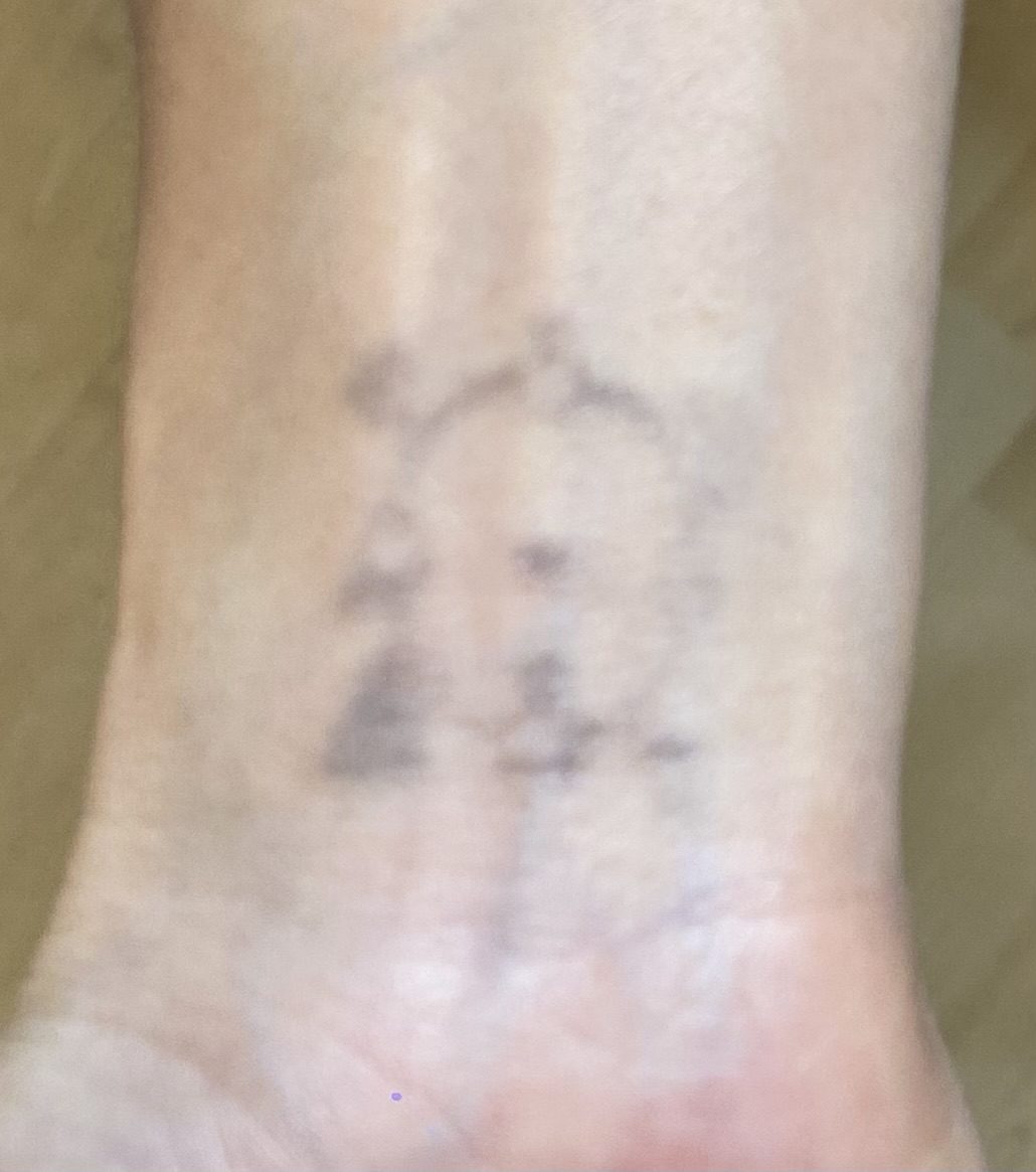 Tattoo after 13 laser tattoo removal sessions at Goodbye Rhonda