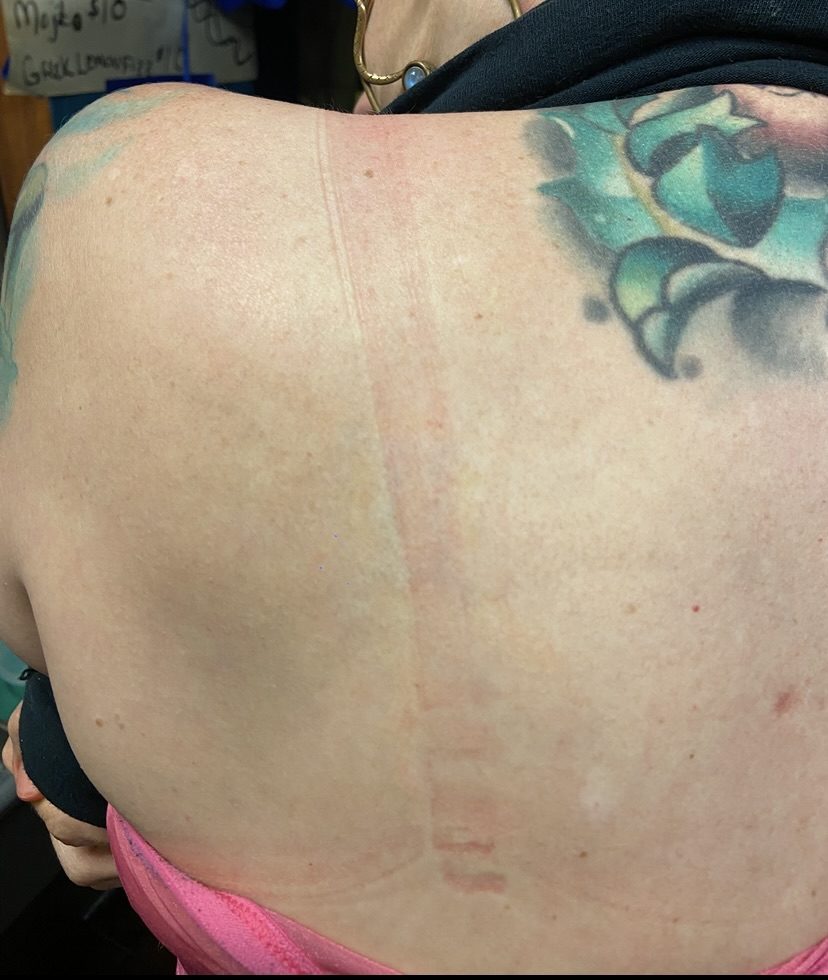 Tattoo after 11 laser tattoo removal sessions at Goodbye Rhonda