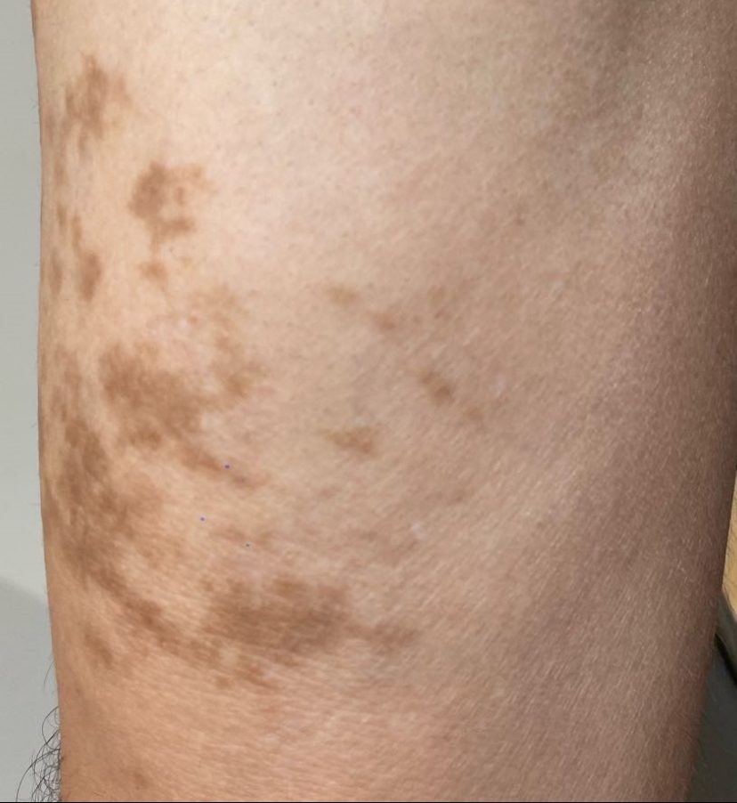 Tattoo after 10 laser tattoo removal sessions at Goodbye Rhonda