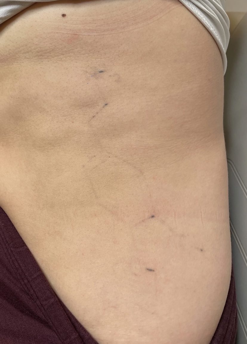 Tattoo after 2 laser tattoo removal sessions at Goodbye Rhonda