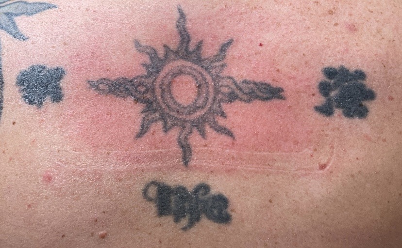 Tattoo before laser tattoo removal at Goodbye Rhonda