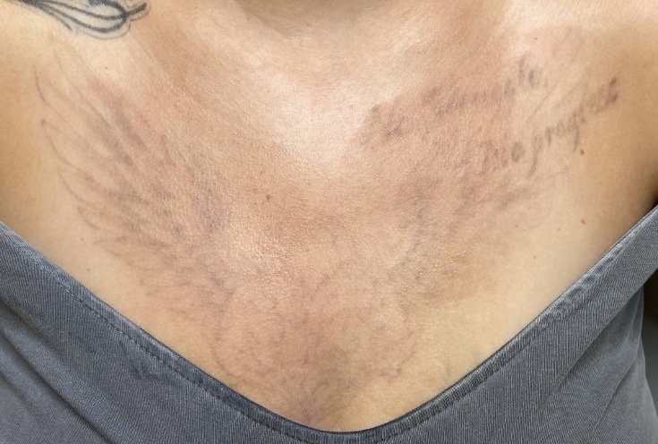 Tattoo after 8 laser tattoo removal sessions at Goodbye Rhonda