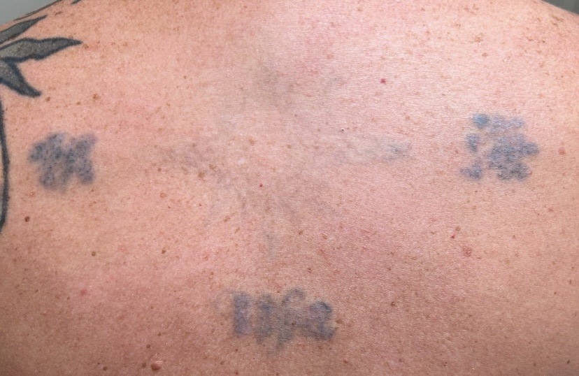 Tattoo after 11 laser tattoo removal sessions at Goodbye Rhonda